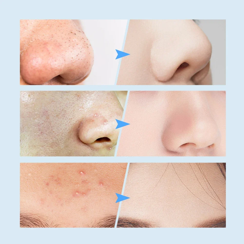 Electric Black Head Suction Instrument Face Cleaner